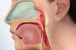 Large Septum Perforation Repair: Restoring Nasal Health with Expert Surgical Techniques thumb-128308