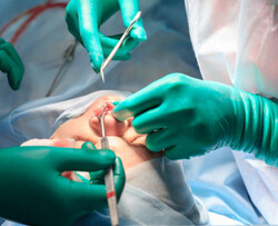 Septal Perforation Surgery London - Expert Treatment for Nasal Septum Perforation thumb-130008