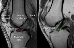 ACL Injuries London thumb-130688